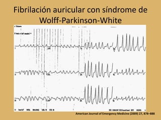 Fibrilación auricular con síndrome de Wolff-Parkinson-WhiteAmerican Journal of Emergency Medicine (2009) 27, 878–888