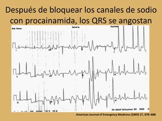 Después de bloquear los canales de sodio con procainamida, los QRS se angostanAmerican Journal of Emergency Medicine (2009) 27, 878–888