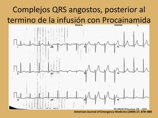 Complejos QRS angostos, posterior al termino de la infusión con ProcainamidaAmerican Journal of Emergency Medicine (2009) 27, 878–888