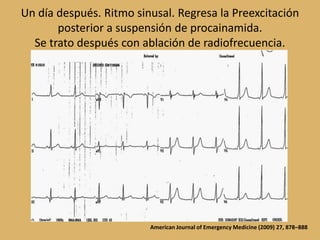 Un día después. Ritmo sinusal. Regresa la Preexcitación posterior a suspensión de procainamida.Se trato después con ablación de radiofrecuencia.American Journal of Emergency Medicine (2009) 27, 878–888