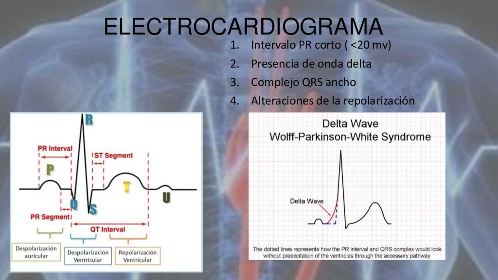 Wolff Parkinson White Si Muore