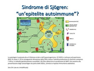Sindrome di Sjögren:Sindrome di Sjögren:
“un’epitelite autoimmune”?“un’epitelite autoimmune”?
La patologia è scatenata da un’infezione virale o dall’ipoestrogenismo. (2) SGECs si attivano ed esprimono
MHC di classe II. (3) la conseguente attivazione delle PDCs induce l’elevata produzione di citochine compreso
l’ IFN α, in individui geneticamente suscettibili. (4) IFN α determina la produzione di BAFF che assieme alla
presentazione degli autoantigeni da parte delle SGECs, stimola la risposta immunitaria adattativa.
(Hui Zhi Low et a lmodificato)
 