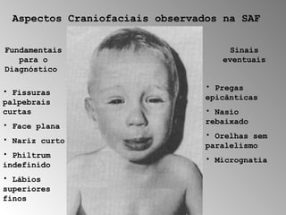 Aspectos Craniofaciais observados na SAF 
Fundamentais 
para o 
Diagnóstico 
• Fissuras 
palpebrais 
curtas 
• Face plana 
• Nariz curto 
• Philtrum 
indefinido 
• Lábios 
superiores 
finos 
Sinais 
eventuais 
• Pregas 
epicânticas 
• Nasio 
rebaixado 
• Orelhas sem 
paralelismo 
• Micrognatia 
 