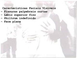 Características Faciais Visíveis 
- Fissuras palpebrais curtas 
- Lábio superior fino 
- Philtrum indefinido 
- Face plana 
 