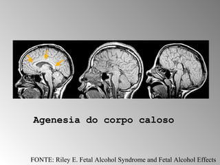 Agenesia do corpo caloso 
FONTE: Riley E. Fetal Alcohol Syndrome and Fetal Alcohol Effects 
 