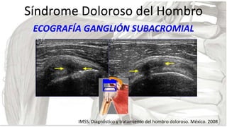 Síndrome Doloroso del Hombro
ECOGRAFÍA GANGLIÓN SUBACROMIAL

IMSS. Diagnóstico y tratamiento del hombro doloroso. México. ...