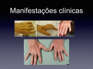 Manifestações clínicas
 