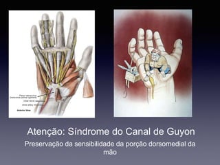 Atenção: Síndrome do Canal de Guyon
Preservação da sensibilidade da porção dorsomedial da
mão
 