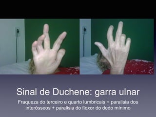 Sinal de Duchene: garra ulnar
Fraqueza do terceiro e quarto lumbricais + paralisia dos
interósseos + paralisia do flexor do dedo mínimo
 