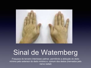 Sinal de Watemberg
Fraqueza do terceiro interósseo palmar, permitindo a abdução do dedo
mínimo pelo extensor do dedo mínimo e comum dos dedos (inervados pelo
nervo radial)
 