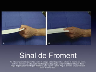 Sinal de Froment
Na mão comprometida (figura A) o adutor do polegar está enfraquecido, e adução do mesmo não ocorre.
De forma alternativa, a articulação interfalangeana do polegar comprometido se flete pelo flexor
longo do polegar (inervado pelo mediano), para segurar o papel. A figura B mostra um paciente sem
lesão do nervo ulnar.
 