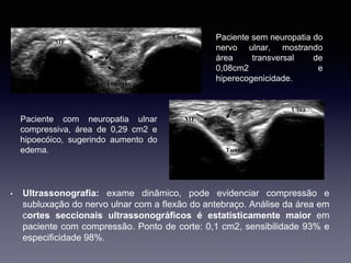• Ultrassonografia: exame dinâmico, pode evidenciar compressão e
subluxação do nervo ulnar com a flexão do antebraço. Análise da área em
cortes seccionais ultrassonográficos é estatisticamente maior em
paciente com compressão. Ponto de corte: 0,1 cm2, sensibilidade 93% e
especificidade 98%.
Paciente com neuropatia ulnar
compressiva, área de 0,29 cm2 e
hipoecóico, sugerindo aumento do
edema.
Paciente sem neuropatia do
nervo ulnar, mostrando
área transversal de
0,08cm2 e
hiperecogenicidade.
 