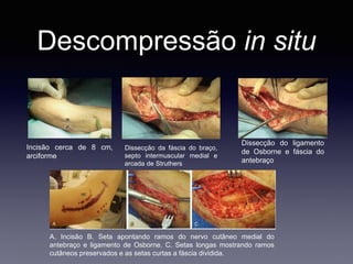 Descompressão in situ
Incisão cerca de 8 cm,
arciforme
Dissecção da fáscia do braço,
septo intermuscular medial e
arcada de Struthers
Dissecção do ligamento
de Osborne e fáscia do
antebraço
A. Incisão B. Seta apontando ramos do nervo cutâneo medial do
antebraço e ligamento de Osborne. C. Setas longas mostrando ramos
cutâneos preservados e as setas curtas a fáscia dividida.
 