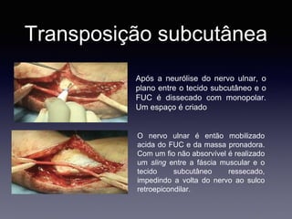 Transposição subcutânea
Após a neurólise do nervo ulnar, o
plano entre o tecido subcutâneo e o
FUC é dissecado com monopolar.
Um espaço é criado
O nervo ulnar é então mobilizado
acida do FUC e da massa pronadora.
Com um fio não absorvível é realizado
um sling entre a fáscia muscular e o
tecido subcutâneo ressecado,
impedindo a volta do nervo ao sulco
retroepicondilar.
 