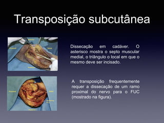Transposição subcutânea
Dissecação em cadáver. O
asterisco mostra o septo muscular
medial, o triângulo o local em que o
mesmo deve ser incisado.
A transposição frequentemente
requer a dissecação de um ramo
proximal do nervo para o FUC
(mostrado na figura).
 