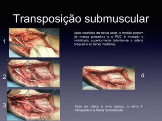 Transposição submuscular
Após neurólise do nervo ulnar, o tendão comum
da massa prosadora e o FUC é incisado e
mobilizado superiormente (atentar-se a artéria
braquial e ao nervo mediano).
Após ser criado o novo espaço, o nervo é
transposto e a fáscia reconstituída
1
2
3
4
 