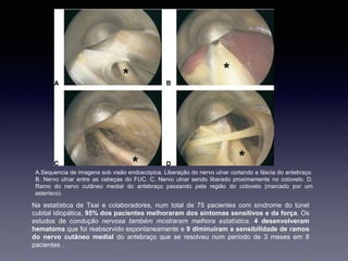 A.Sequencia de imagens sob visão endoscópica. Liberação do nervo ulnar cortando a fáscia do antebraço.
B. Nervo ulnar entre as cabeças do FUC. C. Nervo ulnar sendo liberado proximamente no cotovelo. D.
Ramo do nervo cutâneo medial do antebraço passando pela região do cotovelo (marcado por um
asterisco).
Na estatística de Tsai e colaboradores, num total de 75 pacientes com síndrome do túnel
cubital idiopática, 95% dos pacientes melhoraram dos sintomas sensitivos e da força. Os
estudos de condução nervosa também mostraram melhora estatística. 4 desenvolveram
hematoma que foi reabsorvido espontaneamente e 9 diminuíram a sensibilidade de ramos
do nervo cutâneo medial do antebraço que se resolveu num período de 3 meses em 8
pacientes .
 