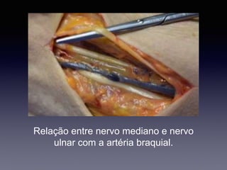 Relação entre nervo mediano e nervo
ulnar com a artéria braquial.
 