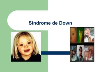 Síndrome de Down 