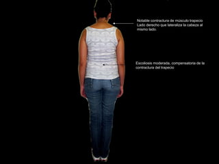 Notable contractura de músculo trapecio
Lado derecho que lateraliza la cabeza al
mismo lado.




Escoliosis moderada, compensatoria de la
contractura del trapecio
 