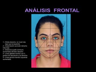 1.- Orbita derecha en nivel más
    bajo que la izquierda.
2.- Implantación auricular derecha
más baja.
3.- Distancia pupila comisura
aumentada del lado derecho
4.- Línea glabela-mentón con 3
grados de desviación a la derecha.
5.- Línea gonión-mentón izquierda
aumentada.
 