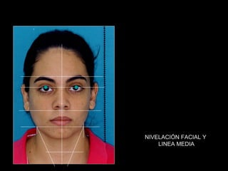 NIVELACIÓN FACIAL Y
    LINEA MEDIA
 