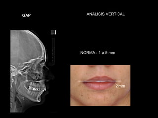 GAP     ANALISIS VERTICAL




      NORMA : 1 a 5 mm




                         2 mm
 