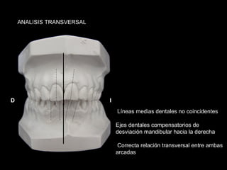 ANALISIS TRANSVERSAL




D                          I
                               Líneas medias dentales no coincidentes

                               Ejes dentales compensatorios de
                               desviación mandibular hacia la derecha

                                Correcta relación transversal entre ambas
                               arcadas
 