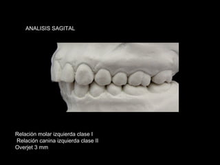 ANALISIS SAGITAL




Relación molar izquierda clase I
Relación canina izquierda clase II
Overjet 3 mm
 