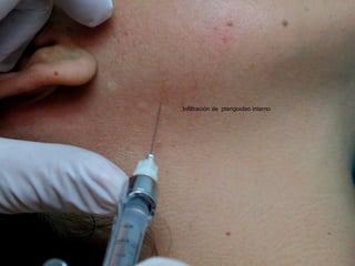 Infiltración de pterigoideo interno
 