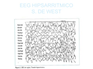EEG HIPSARRITMICO
S. DE WEST
 