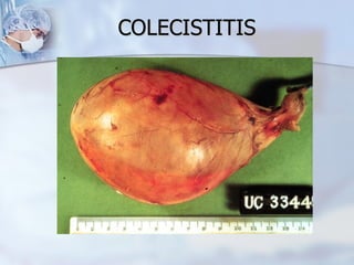 COLECISTITIS   
