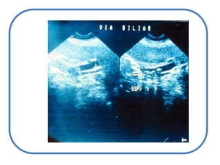 Cirrosis (sobretodo CBP)