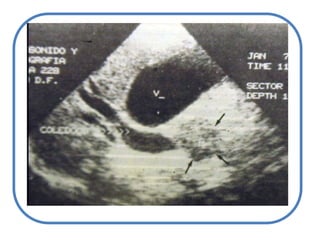 Tumores: víabiliar, páncreas o encrucijada