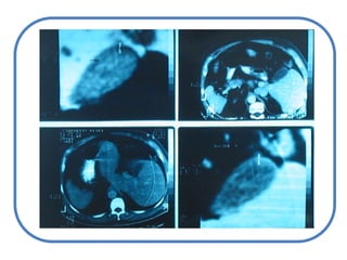 Síndrome de GilbertHerencia autosómica recesivaDefiniciónInserción bases en el promotor (caja TATA) Alteración hereditaria multifactorial asociada a un elevado nivel de bilirrubina (Hiperbillirrubinemia no conjugada) en sangreEl principal síntoma es la aparición de ictericia leve (coloración amarillenta de la piel), principalmente en épocas de mucho estrés, esfuerzo, depresión, enfermedad o mala alimentación