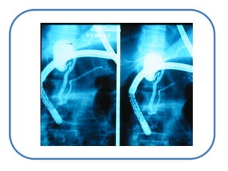 Síndrome de criglernajjar IIMas frecuente que el CN  Tipo I. Llegan a la vida adulta, noGran mortalidad infantil.Reducción en la actividad de la glucuronosiltransferasa de UDP Ictericia variable: bilirrubi6 – 25 mg/dl. Biopsia y función hepaticanormal.
