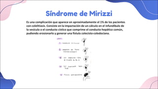 Síndrome de Mirizzi
Es una complicación que aparece en aproximadamente el 1% de los pacientes
con colelitiasis. Consiste en la impactación de un cálculo en el infundíbulo de
la vesícula o el conducto cístico que comprime el conducto hepático común,
pudiendo erosionarlo y generar una fístula colecisto-coledociana.
 