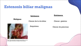 Estenosis biliar malignas
Malignas
Intrínseca
Cáncer de la vía biliar
Ampuloma
Cáncer gástrico
Cáncer de páncreas
Extrínseca
 
