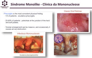 Síndrome Monolike - Clínica da Mononucleose
 