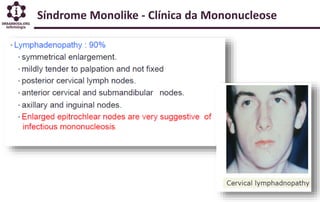 Síndrome Monolike - Clínica da Mononucleose
 