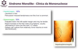 Síndrome Monolike - Clínica da Mononucleose
 