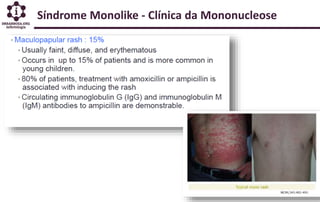 Síndrome Monolike - Clínica da Mononucleose
 