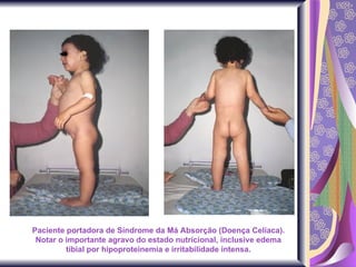 Paciente portadora de Síndrome da Má Absorção (Doença Celíaca). Notar o importante agravo do estado nutricional, inclusive edema tibial por hipoproteinemia e irritabilidade intensa. 