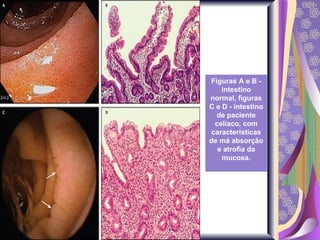 Figuras A e B - intestino normal, figuras C e D - intestino de paciente celíaco, com características de má absorção e atrofia da mucosa. 