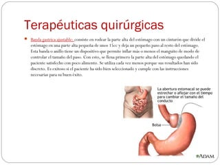 Terapéuticas quirúrgicas
 Banda gastrica ajustable: consiste en rodear la parte alta del estómago con un cinturón que divide el
estómago en una parte alta pequeña de unos 15cc y deja un pequeño paso al resto del estómago.
Esta banda o anillo tiene un dispositivo que permite inflar más o menos el manguito de modo de
controlar el tamaño del paso. Con esto, se llena primero la parte alta del estómago quedando el
paciente satisfecho con poco alimento. Se utiliza cada vez menos porque sus resultados han sido
discreto. Es exitoso si el paciente ha sido bien seleccionado y cumple con las instrucciones
necesarias para su buen éxito. 
 
