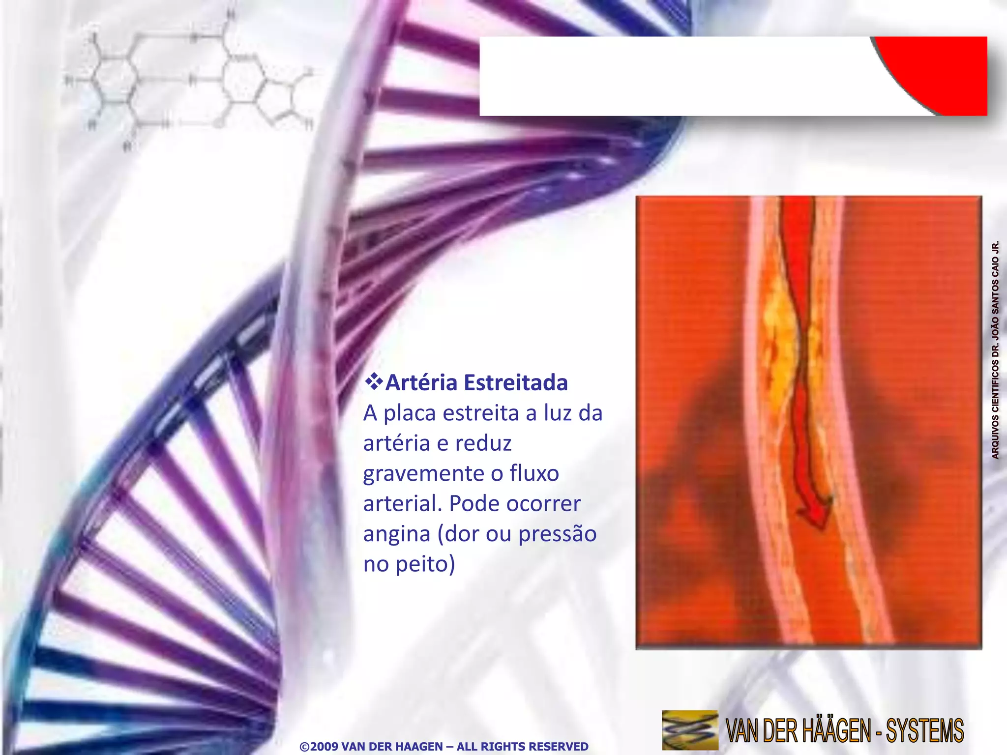 Artéria Estreitada
         A placa estreita a luz da
         artéria e reduz
         gravemente o fluxo
         arterial. Pode ocorrer
         angina (dor ou pressão
         no peito)




©2009 VAN DER HAAGEN – ALL RIGHTS RESERVED
 