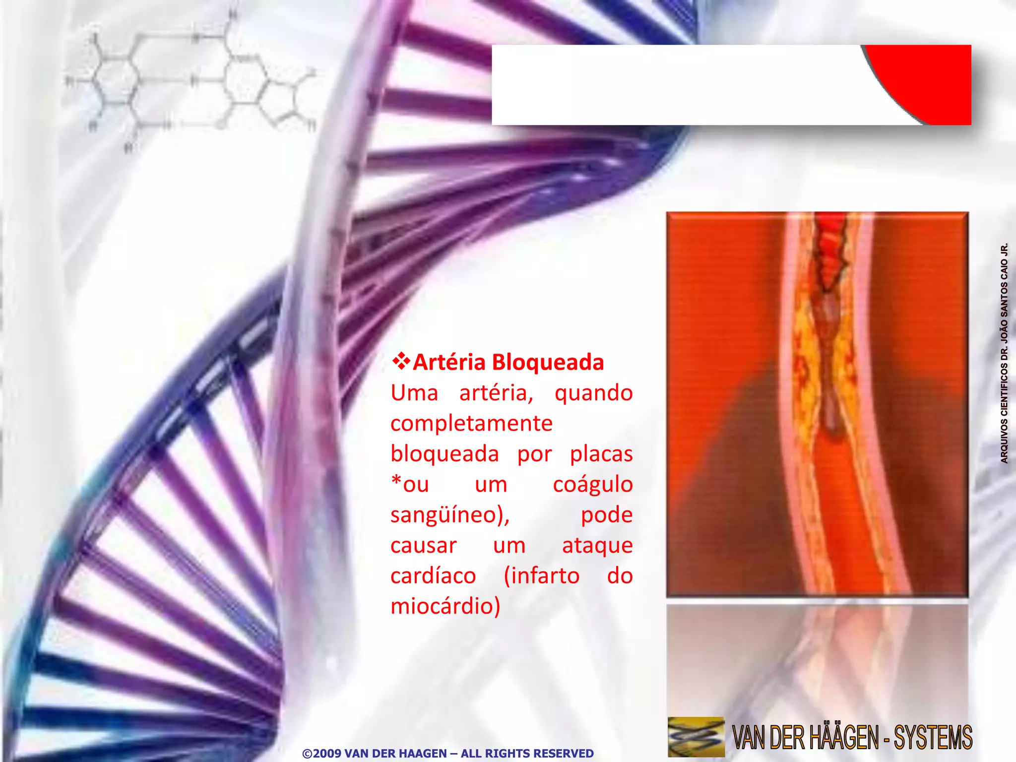 Artéria Bloqueada
            Uma artéria, quando
            completamente
            bloqueada por placas
            *ou     um    coágulo
            sangüíneo),      pode
            causar um ataque
            cardíaco (infarto do
            miocárdio)




©2009 VAN DER HAAGEN – ALL RIGHTS RESERVED
 