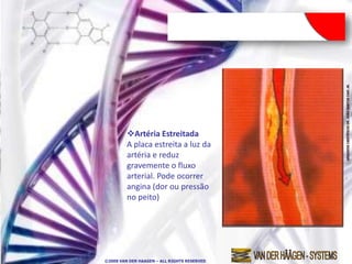 Artéria Estreitada
         A placa estreita a luz da
         artéria e reduz
         gravemente o fluxo
         arterial. Pode ocorrer
         angina (dor ou pressão
         no peito)




©2009 VAN DER HAAGEN – ALL RIGHTS RESERVED
 