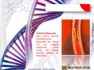 Artéria Bloqueada
            Uma artéria, quando
            completamente
            bloqueada por placas
            *ou     um    coágulo
            sangüíneo),      pode
            causar um ataque
            cardíaco (infarto do
            miocárdio)




©2009 VAN DER HAAGEN – ALL RIGHTS RESERVED
 