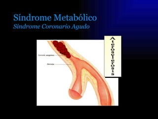 Síndrome Metabólico
Síndrome Coronario Agudo
 